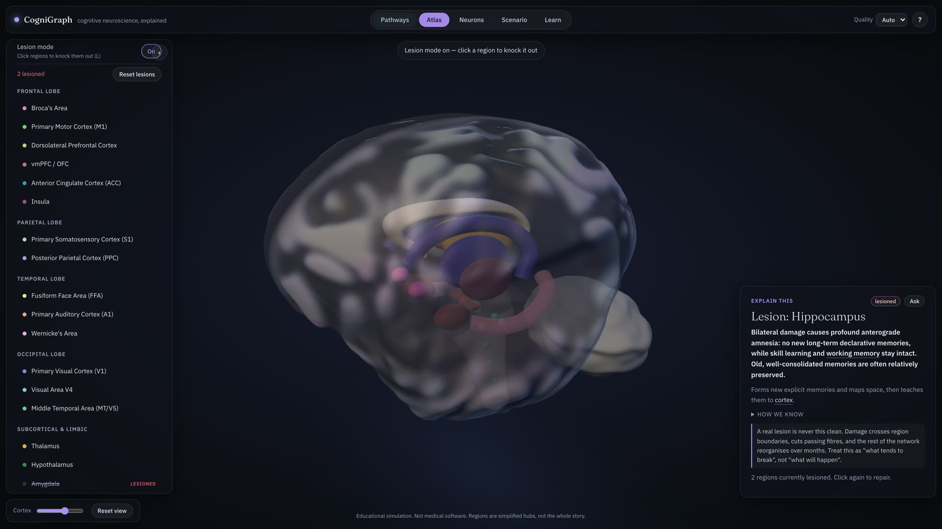Atlas mode with lesion mode on: the region list grouped by lobe, two regions marked lesioned, and a card titled Lesion: Hippocampus describing anterograde amnesia.